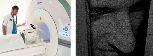 Eksempel på en prototype til bevægelseskorrektion (Tracoline 2.0 by TracInnovations) i brug på en af MR-skannerne på Rigshospitalet. Billedet til venstre viser skanningen af en frivillig med Tracoline 2.0 i brug, som er påsat MR-scannerens hovedspole. På billedet til højre kan man se den overflade som Tracoline 2.0 rekonstruerer for at følge patientens bevægelser.