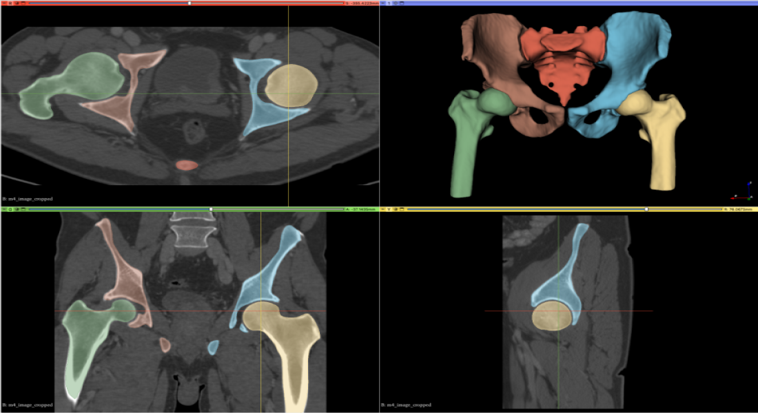 Digital twins of hip joint 